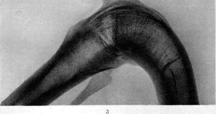 Ankylosis: figure 6 from the 1928–1936 encyclopedia article