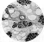 Diabetes Mellitus: figure 5 from the 1928–1936 encyclopedia article