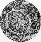 Diabetes Mellitus: figure 7 from the 1928–1936 encyclopedia article