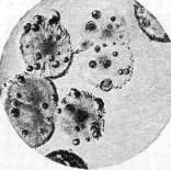 Diabetes Mellitus: figure 3 from the 1928–1936 encyclopedia article