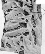 Diabetes Mellitus: figure 2 from the 1928–1936 encyclopedia article