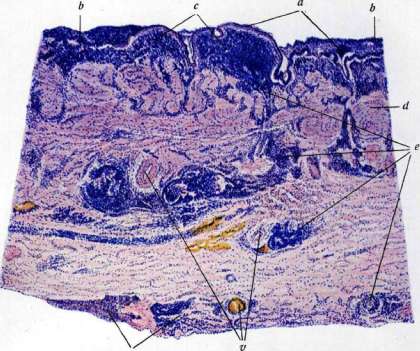 Inflammation: figure 6 from the 1928–1936 encyclopedia article