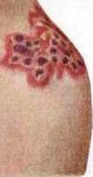 Herpes: figure 2 from the 1928–1936 encyclopedia article