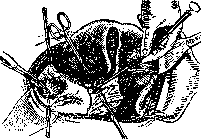 Gallbladder: figure 55 from the 1928–1936 encyclopedia article