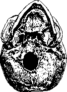 Torticollis: figure 3 from the 1928–1936 encyclopedia article
