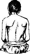 Torticollis: figure 2 from the 1928–1936 encyclopedia article