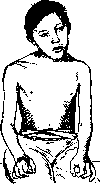 Torticollis: figure 1 from the 1928–1936 encyclopedia article