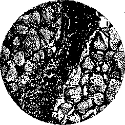 Graves' Disease: figure 5 from the 1928–1936 encyclopedia article