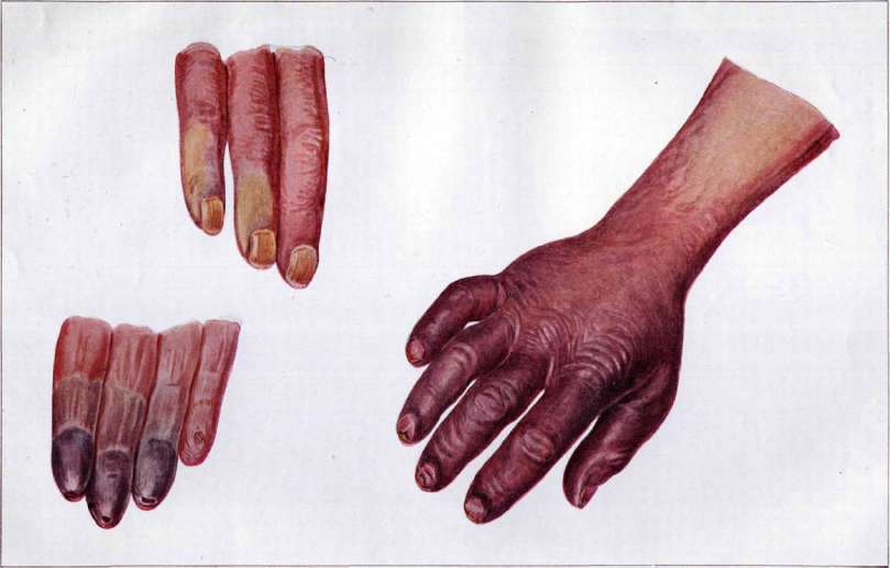 Angiostoma: figure 1 from the 1928–1936 encyclopedia article
