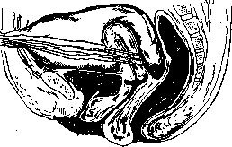 Radiotherapy: figure 9 from the 1928–1936 encyclopedia article