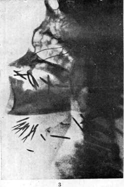 Radiotherapy: figure 5 from the 1928–1936 encyclopedia article