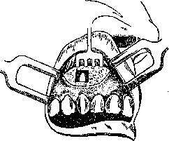 Alveolotomy: figure 1 from the 1928–1936 encyclopedia article