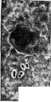 Pneumonia: figure 8 from the 1928–1936 encyclopedia article