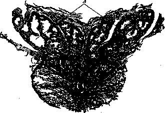 Vesiculitis: figure 1 from the 1928–1936 encyclopedia article