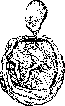 Acardius: figure 2 from the 1928–1936 encyclopedia article