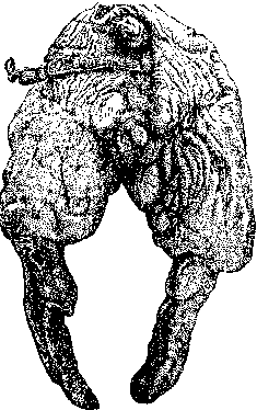 Acardius: figure 1 from the 1928–1936 encyclopedia article