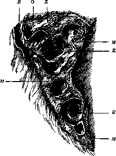 Bronchiectasis: figure 1 from the 1928–1936 encyclopedia article