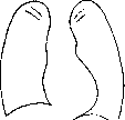 Heart Defects: figure 3 from the 1928–1936 encyclopedia article