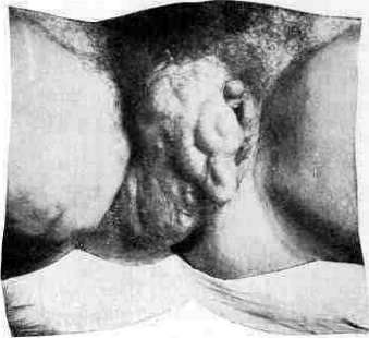 Varicose Veins: figure 2 from the 1928–1936 encyclopedia article