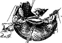 Salpingotomy: figure 2 from the 1928–1936 encyclopedia article