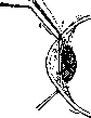 Iridectomy: figure 3 from the 1928–1936 encyclopedia article