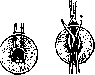 Iridectomy: figure 4 from the 1928–1936 encyclopedia article