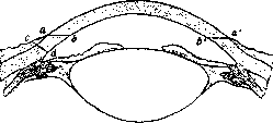 Iridectomy: figure 5 from the 1928–1936 encyclopedia article