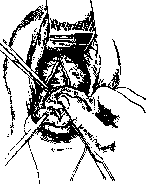 Hysterotomy: figure 1 from the 1928–1936 encyclopedia article