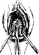 Hysterotomy: figure 2 from the 1928–1936 encyclopedia article