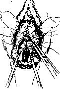 Hysterotomy: figure 3 from the 1928–1936 encyclopedia article