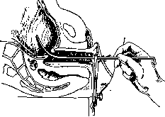 Breech Presentation: figure 61 from the 1928–1936 encyclopedia article