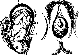 Breech Presentation: figure 33 from the 1928–1936 encyclopedia article