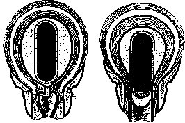 Breech Presentation: figure 12 from the 1928–1936 encyclopedia article