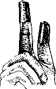 Breech Presentation: figure 67 from the 1928–1936 encyclopedia article