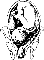 Breech Presentation: figure 42 from the 1928–1936 encyclopedia article