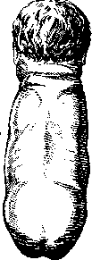 Breech Presentation: figure 14 from the 1928–1936 encyclopedia article