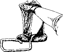 Breech Presentation: figure 24 from the 1928–1936 encyclopedia article