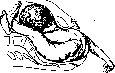 Breech Presentation: figure 37 from the 1928–1936 encyclopedia article