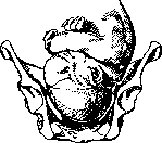 Breech Presentation: figure 3 from the 1928–1936 encyclopedia article