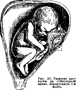Breech Presentation: figure 47 from the 1928–1936 encyclopedia article