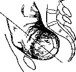 Breech Presentation: figure 2 from the 1928–1936 encyclopedia article