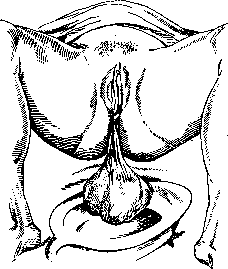 Breech Presentation: figure 20 from the 1928–1936 encyclopedia article