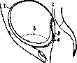 Breech Presentation: figure 49 from the 1928–1936 encyclopedia article