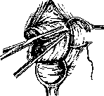 Breech Presentation: figure 56 from the 1928–1936 encyclopedia article