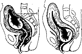 Childbirth: figure 9 from the 1928–1936 encyclopedia article