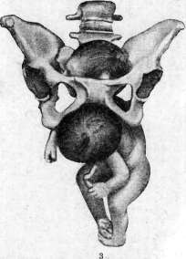 Breech Presentation: figure 55 from the 1928–1936 encyclopedia article