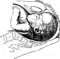 Childbirth: figure 11 from the 1928–1936 encyclopedia article