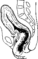 Childbirth: figure 8 from the 1928–1936 encyclopedia article