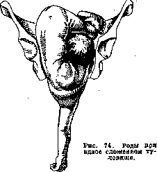 Breech Presentation: figure 38 from the 1928–1936 encyclopedia article