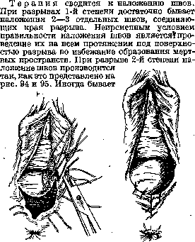 Breech Presentation: figure 59 from the 1928–1936 encyclopedia article